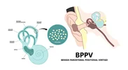 سرگیجه وضعیتی خوشخیم (BPPV)