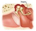 اتواسکلروزیس (Otosclerosis)